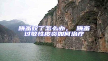 跳蚤咬了怎么辦, 跳蚤過敏性皮炎如何治療